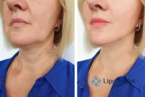 Double chin before and after Hi-Fu treatment 4 Book your double chin treatment Ossett today! We are here to help!