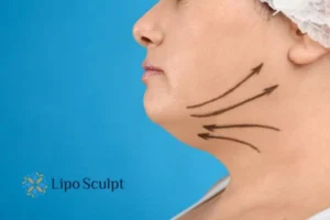 Double chin before and after Hi-Fu treatment 3 Boost your confidence with a Double chin treatment Ossett