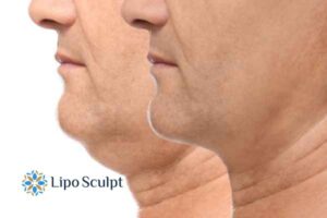 Double chin before and after Hi-Fu treatment 2 Double chin treatment Ossett from Lipo Sculpt - feel more confident today!