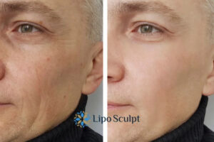 How to Fight Aging Symptoms 3 Fight Aging Symptoms Ossett With HIFU and Morpheus8 Today!