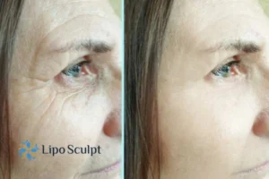 How to Fight Aging Symptoms 2 Do you want to Fight Aging Symptoms Ossett? Contact Lipo Sculpt today!