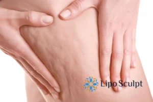 CoolSculpting for Legs: The Innovative Approach to Redefining Your Legs 5 Start your journey today book your coolsculpting treatment Ossett online today!